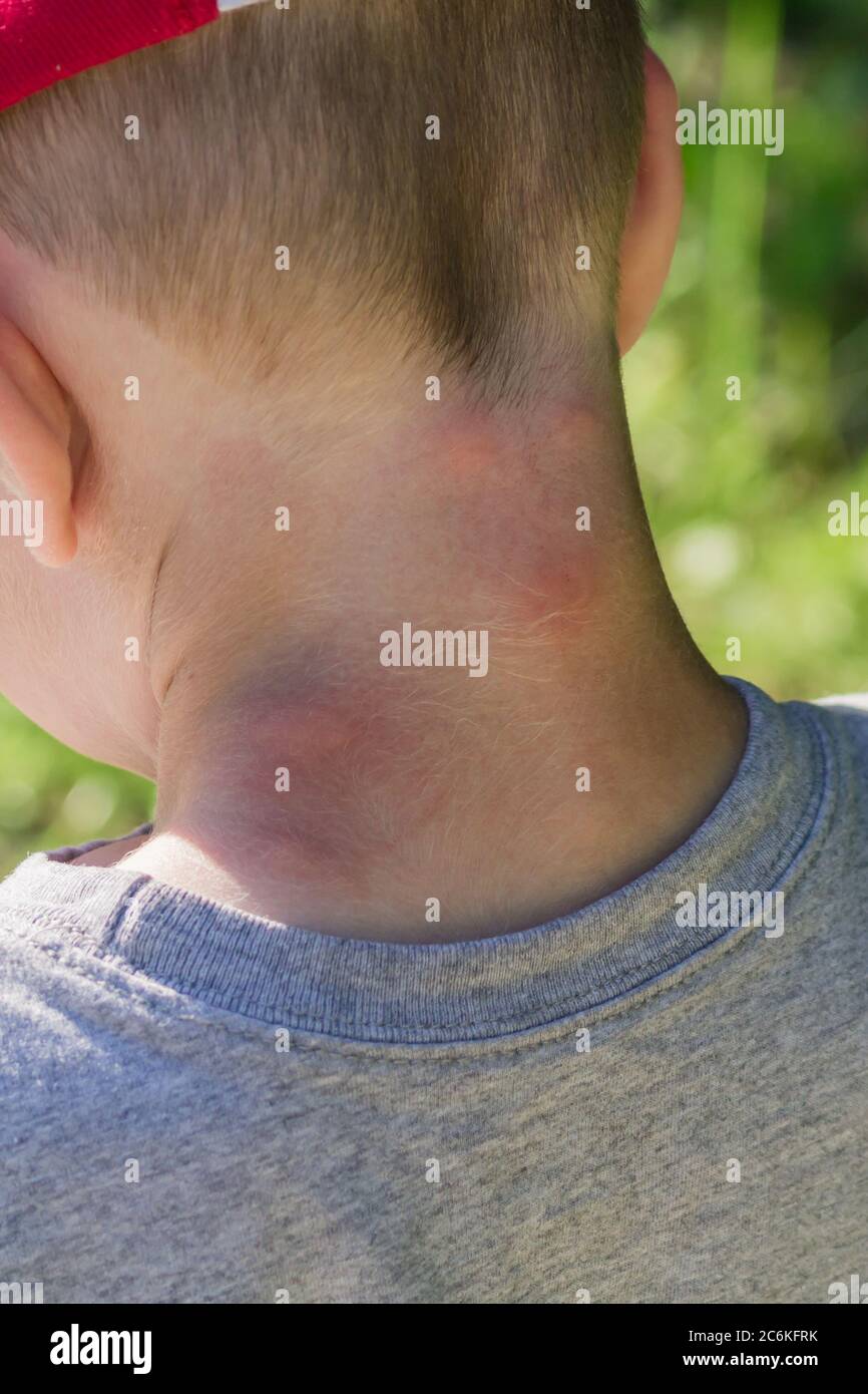 Allergic Reaction Insect Bite High Resolution Stock Photography and