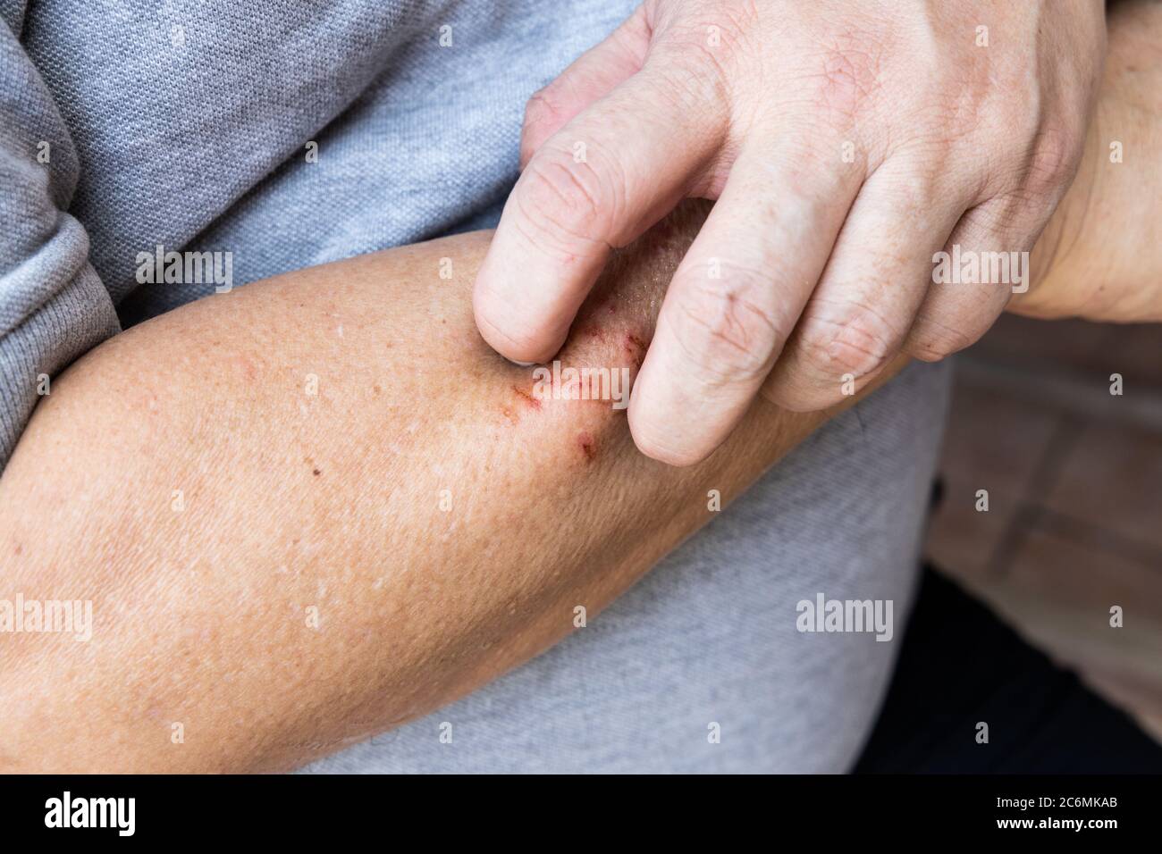 Person scratching itchy and irritating wound on hand skin due allergy Stock Photo