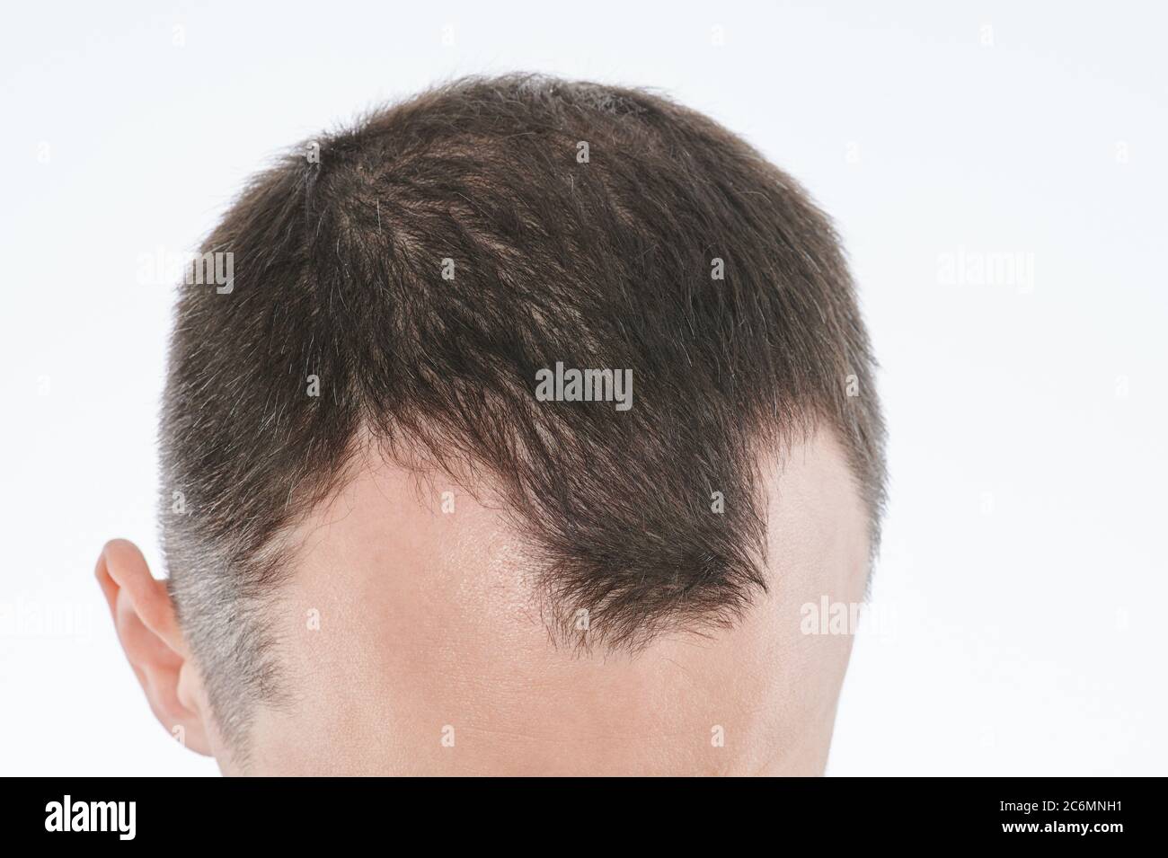 Man loosing hair theme. Head with sort hair and baldness spot Stock Photo - Alamy Man loosing hair theme. Head with sort hair and baldness spot Stock Photo - Alamy