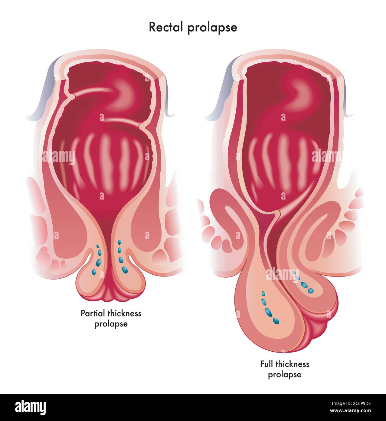 Medical illustration showing two types of rectal prolapse, a partial thickness prolapse, and a full thickness prolapsed. Stock Photo
