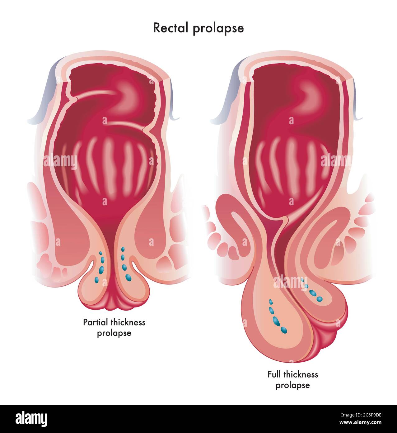 Medical Illustration Showing Two Types Of Rectal Prolapse A Partial Medical Illustration Showing Two Types Of Rectal Prolapse A Partial