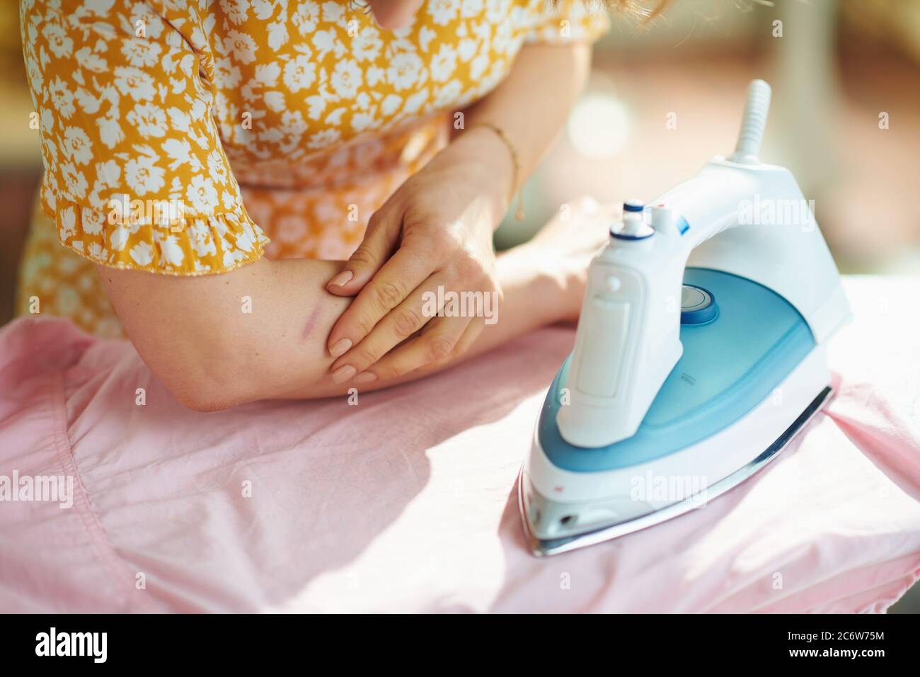 Closeup on woman in the house in sunny day have iron burn mark on arm. Stock Photo