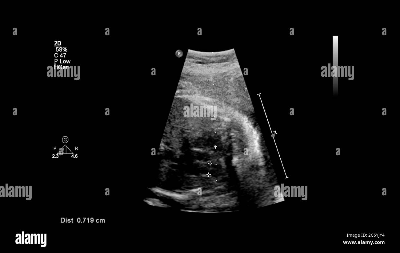 Ultrasound photography hi-res stock photography and images - Page 3 - Alamy