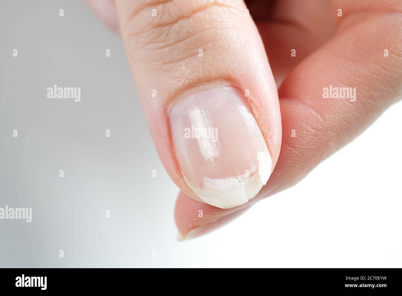 Peeling fingertips - Apple Community