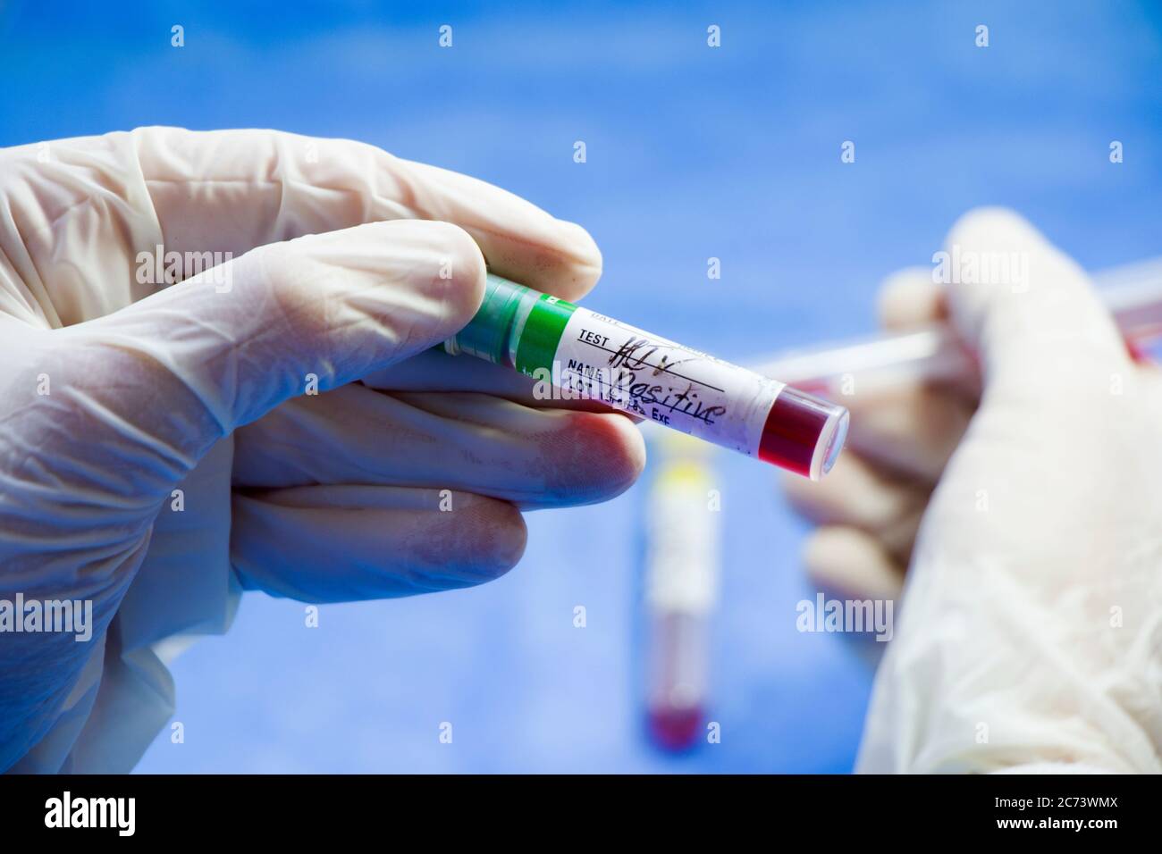 Hiv and aids infection test, hand and tube with blood on the blue background. Studio shoot Stock