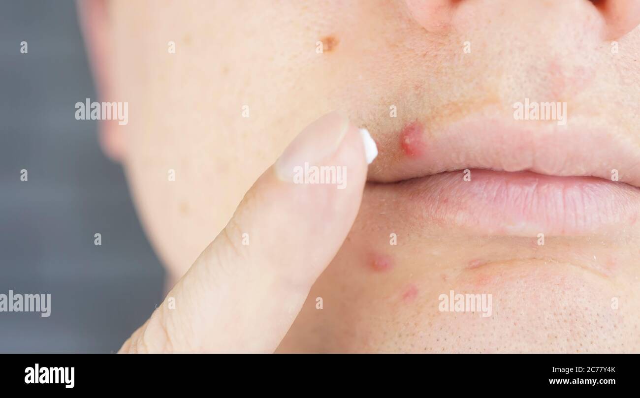 big red acne on the lip, macro shot Stock Photo Alamy