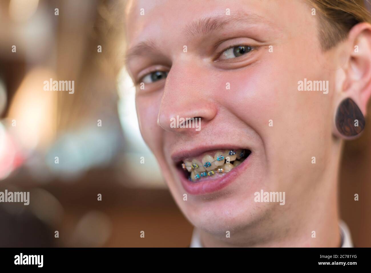 Portrait of a twenty five year old guy with braces on his teeth, smiling. Wrong bite in a young smiling guy. Dental pathology, correction of Stock Photo
