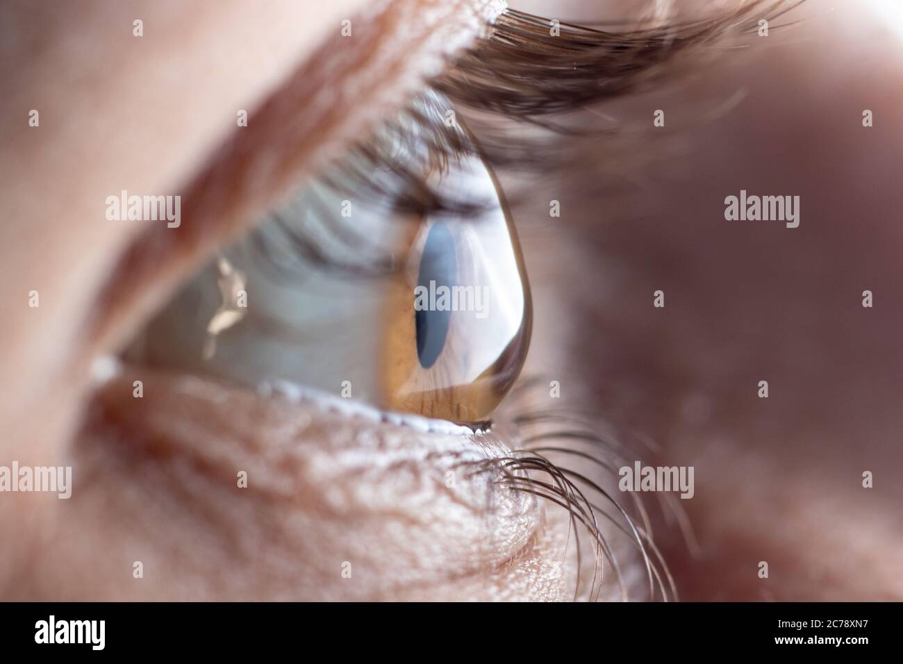 Macro picture of the eye. The cornea in the form of a cone, the disease of the eye keratoconus. Astigmatism. Stock Photo