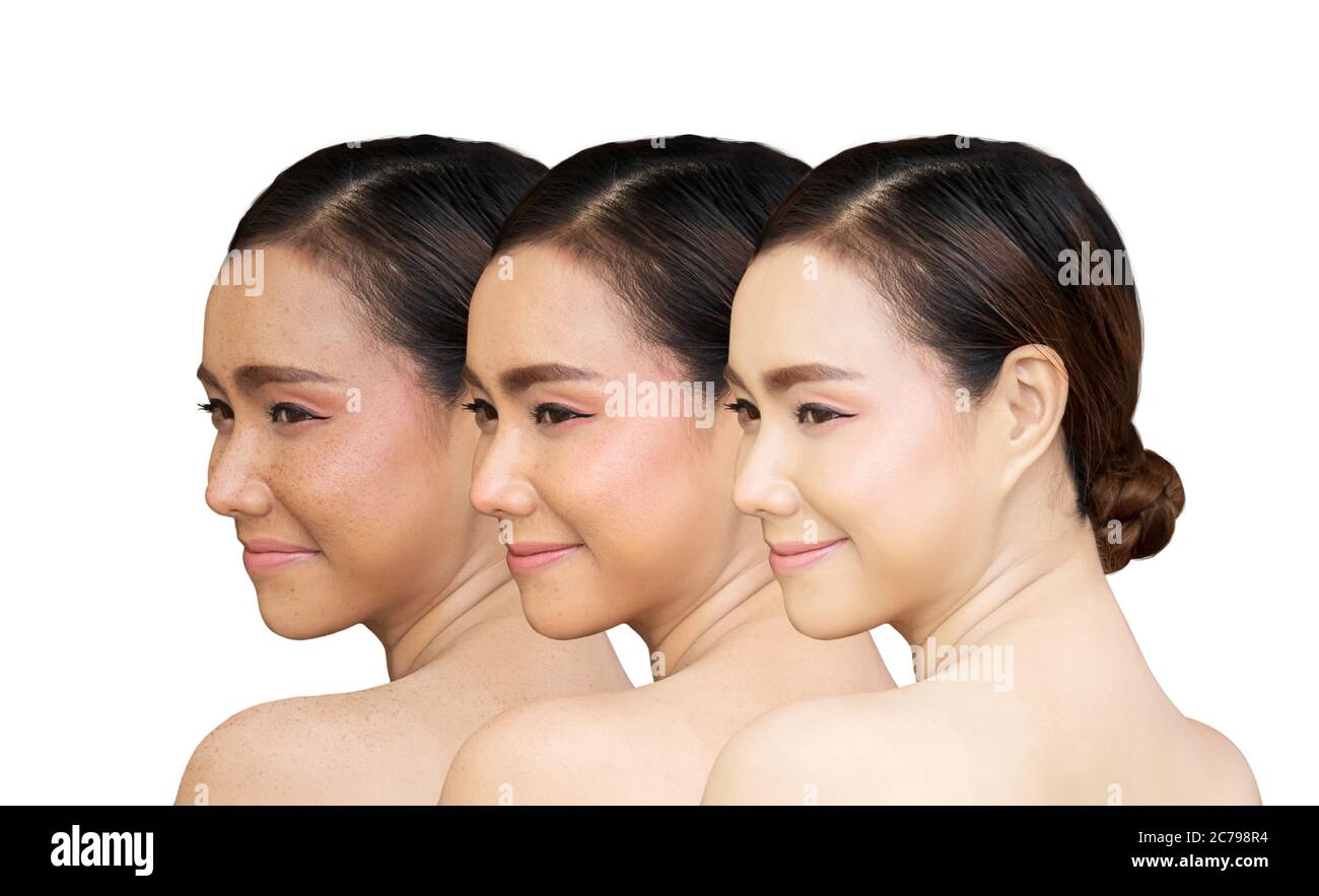 three pictures compared before and after treatment for freckles , freckles pigment spot removing and healing before and after laser treatment on Asian Stock Photo