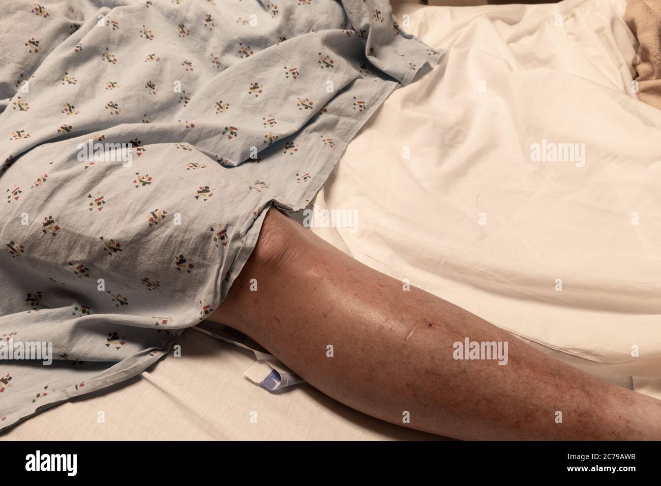 Single leg of an amputee man in a hospital bed partially covered with a gown, disabled, veteran, cancer, coronavirus, healthcare background, horizonta Stock Photo