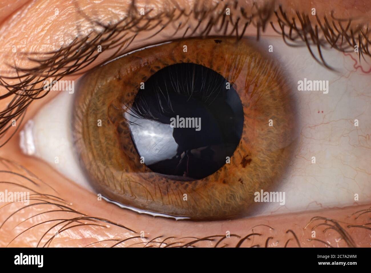 Keratoconus of eye, 4th degree. Contortion of the cornea in the form of a cone, deterioration of vision, astigmatism. Macro close up. Stock Photo