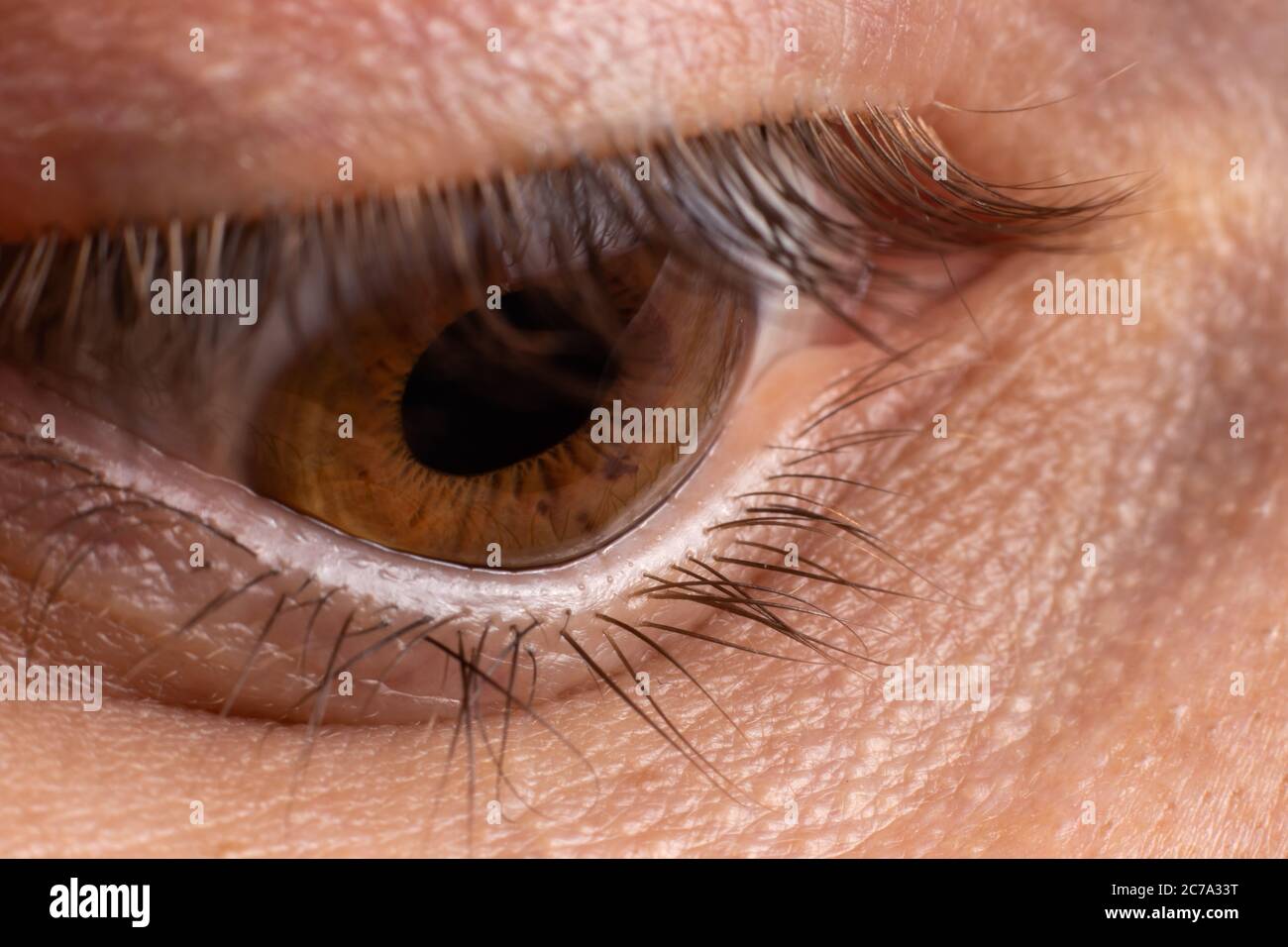 Macro eye photo. Keratoconus 4 degree - eye disease, thinning of the cornea in the form of a cone. The cornea plastic. Stock Photo