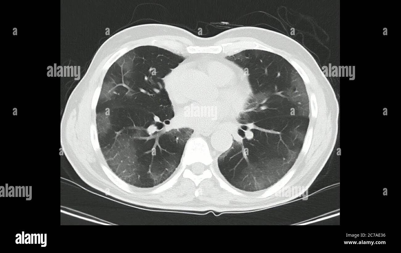 Computed Tomography of the chest (high resolution CT chest)   in a confirmed case of COVID-19 (Corona virus) showing changes in both lungs Stock Photo