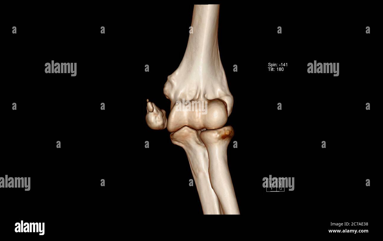 Computed Tomography Volume Rendering examination of the Elbow joint ( CT VR Elbow) showing fracture of the medial epicondyle Stock Photo