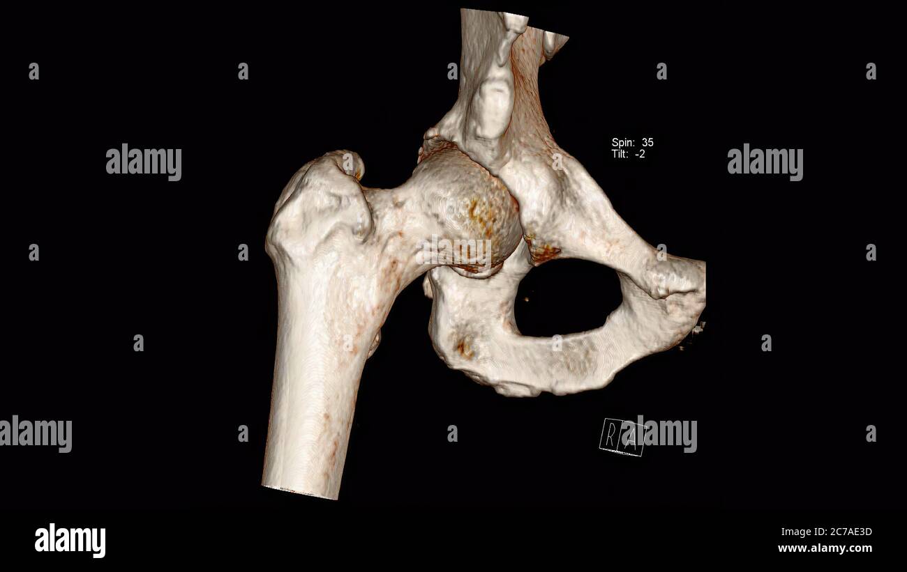 Computed Tomography Volume Rendering examination of the  Hip joint ( CT VR Hip) Stock Photo