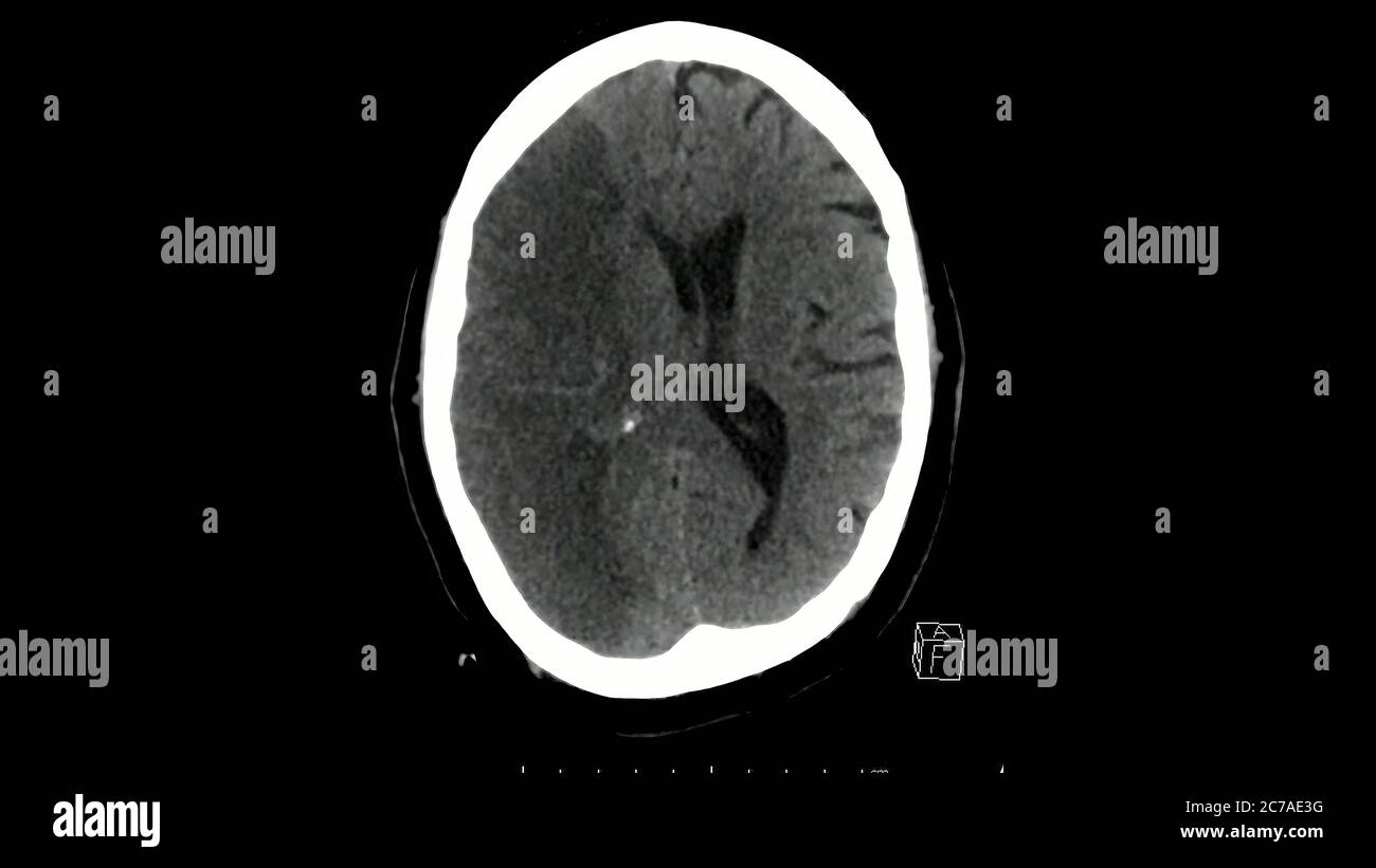 Computed tomography scan of the brain axial cut showing massive right middle cerebral artery infarction Stock Photo
