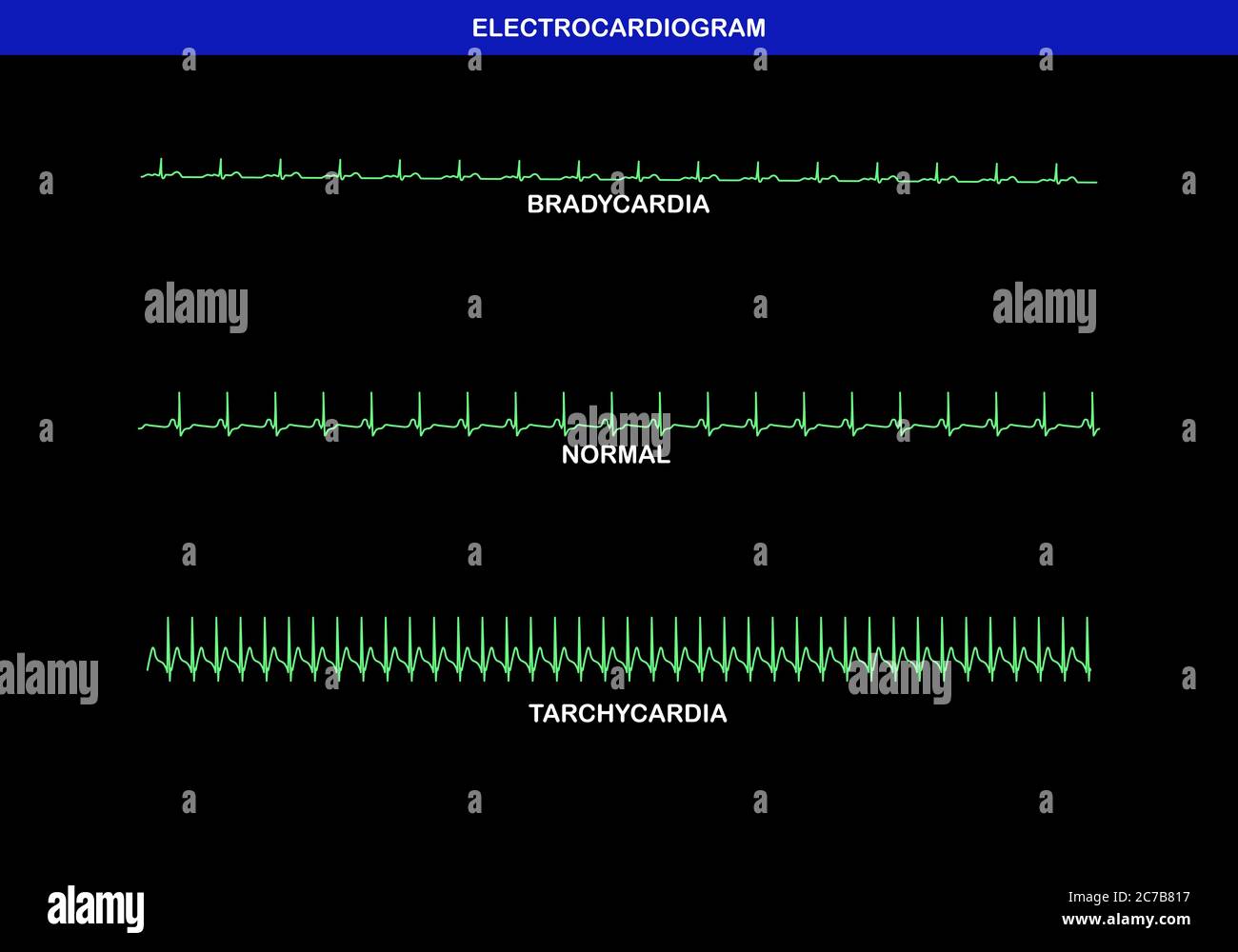 gabapentin slow heart rate