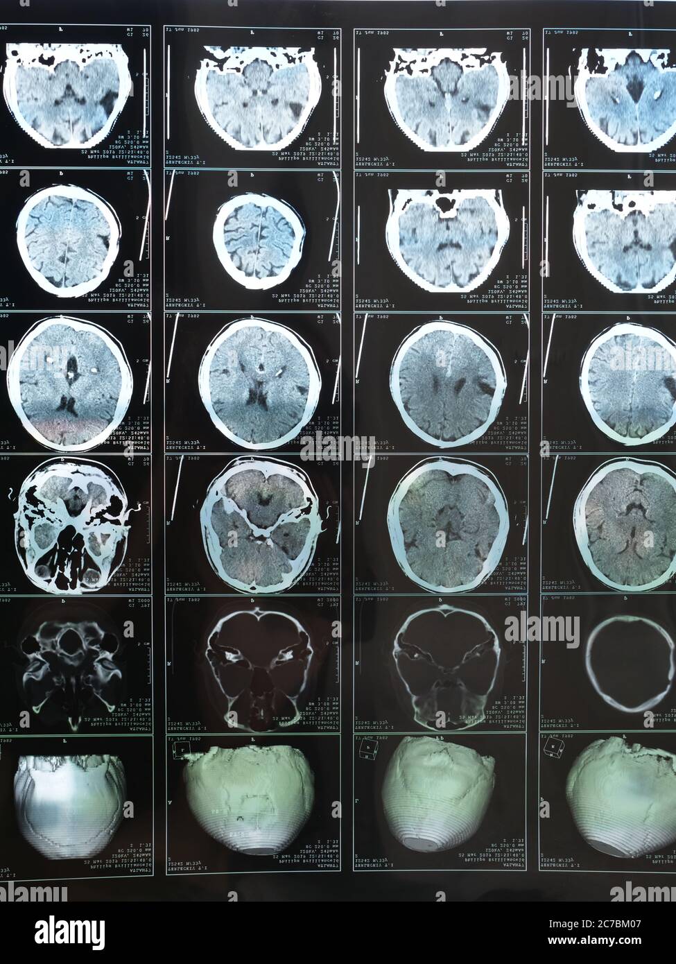 MRI of the braiMRI scan of the human brain after traumatic brain injuryn after trauma. High quality photo Stock Photo