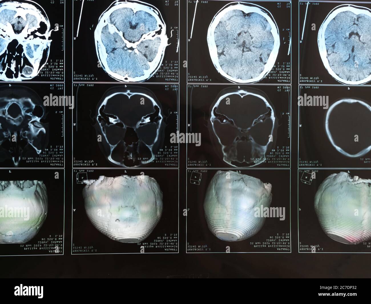 This stock photo shows a magnetic resonance imaging MRI of the brain after traumatic brain injury, showing that the brain is damaged Stock Photo