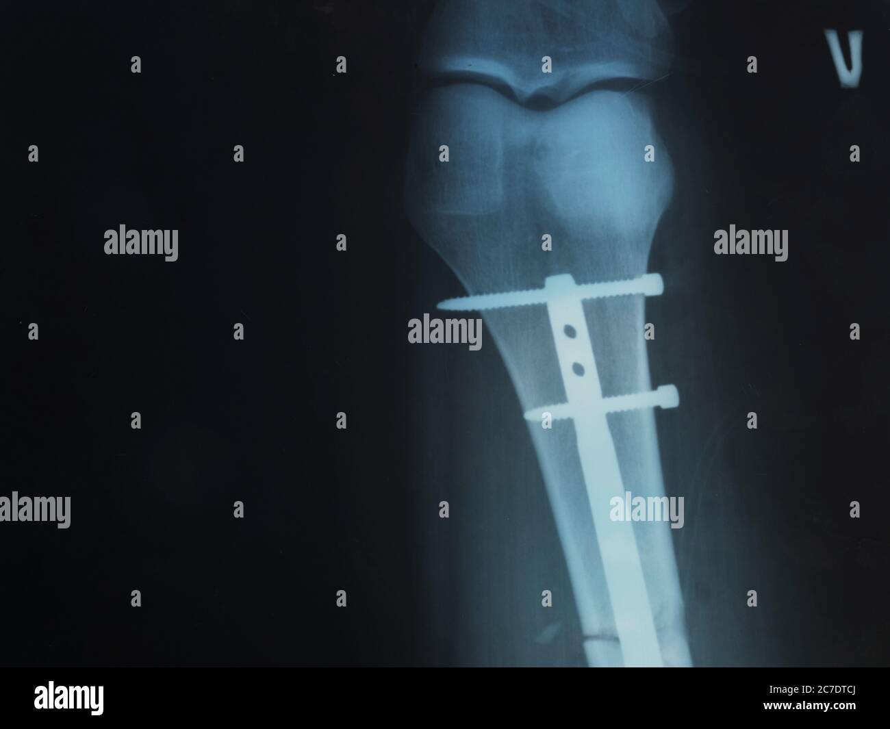 Iron leg hires stock photography and images Alamy