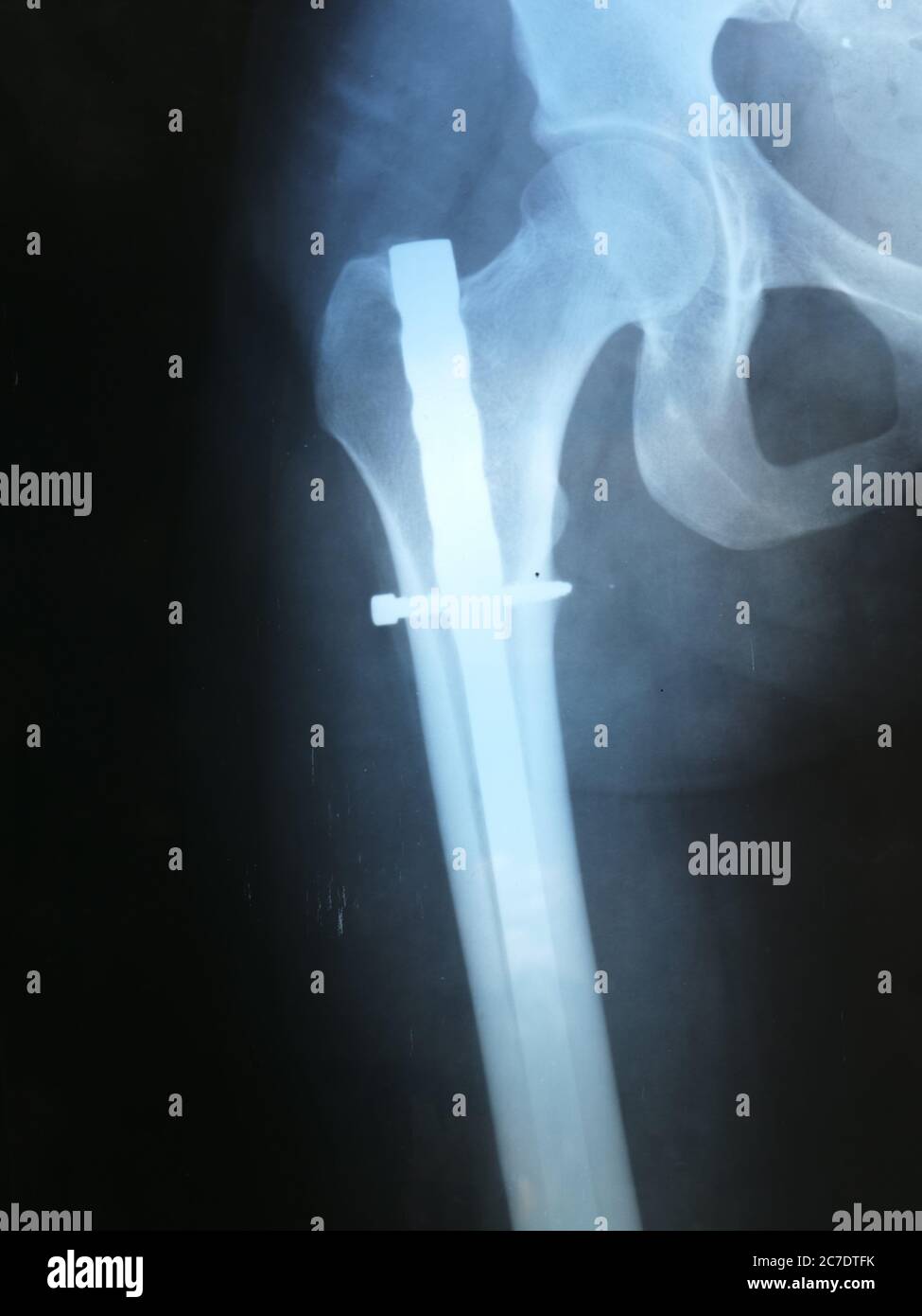 This stock photo shows the X-ray of a femur after surgery with the addition of an iron needle after a fracture Stock Photo