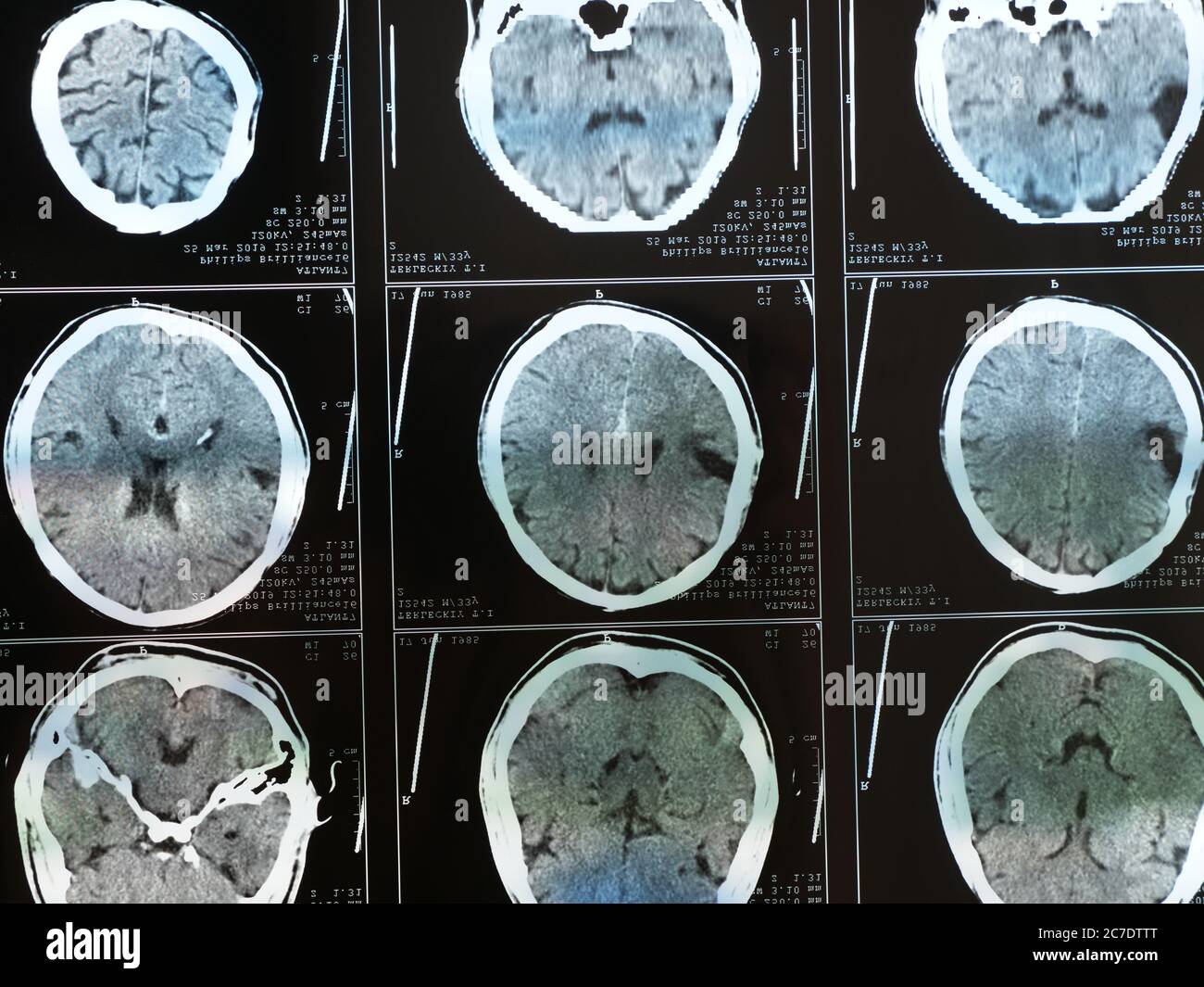 This stock photo shows a magnetic resonance imaging MRI of the brain after traumatic brain injury, showing that the brain is damaged Stock Photo