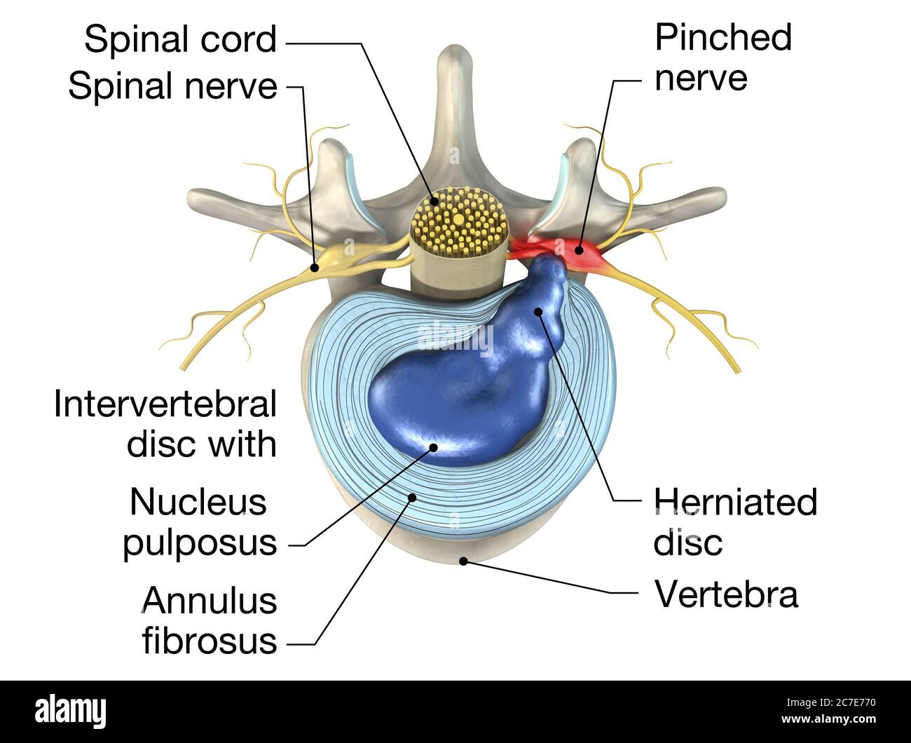 3D illustration showing painful herniated disc or slipped disc Stock