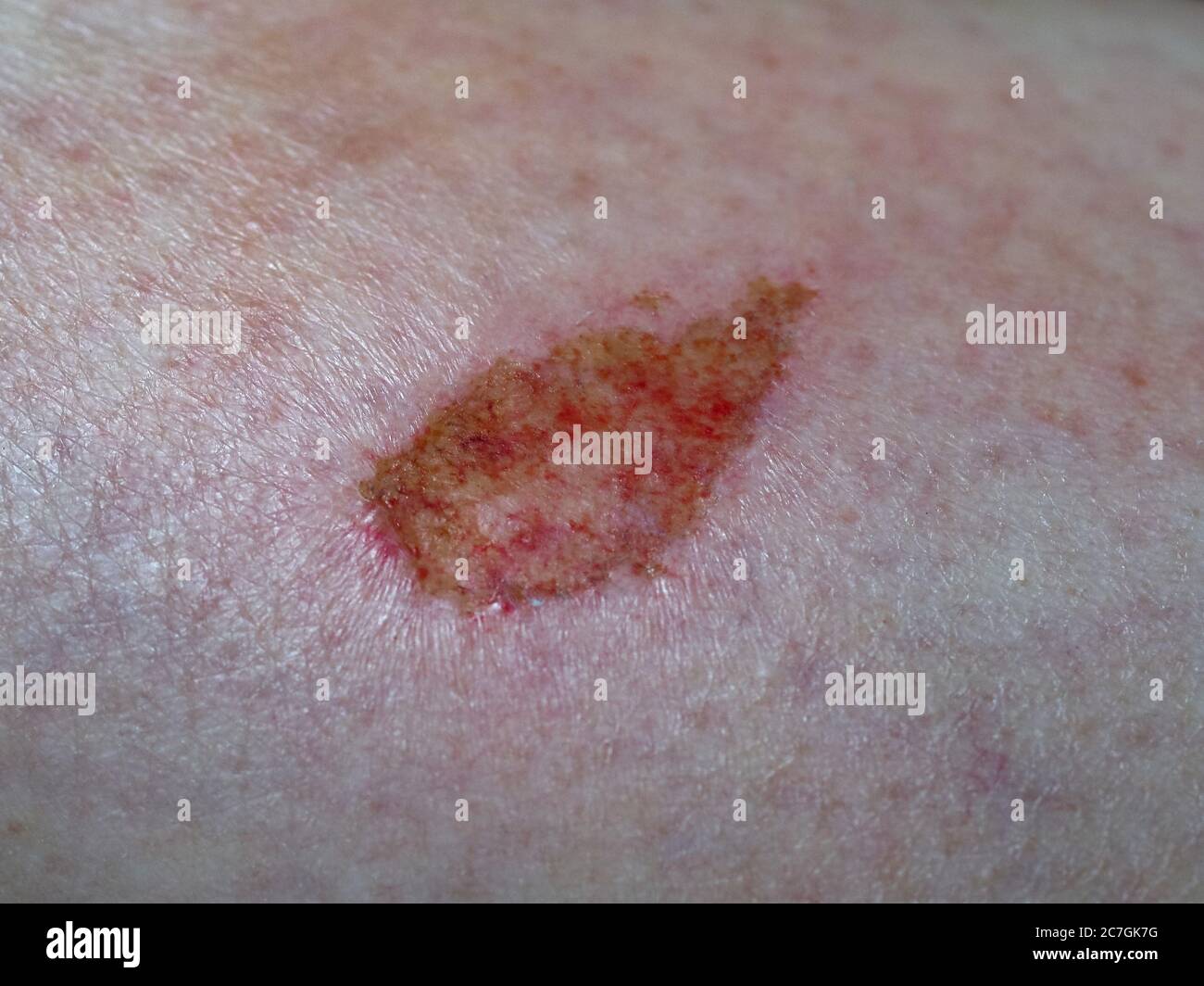 scar tissue following abrasion graze on human limb skin Stock Photo Alamy