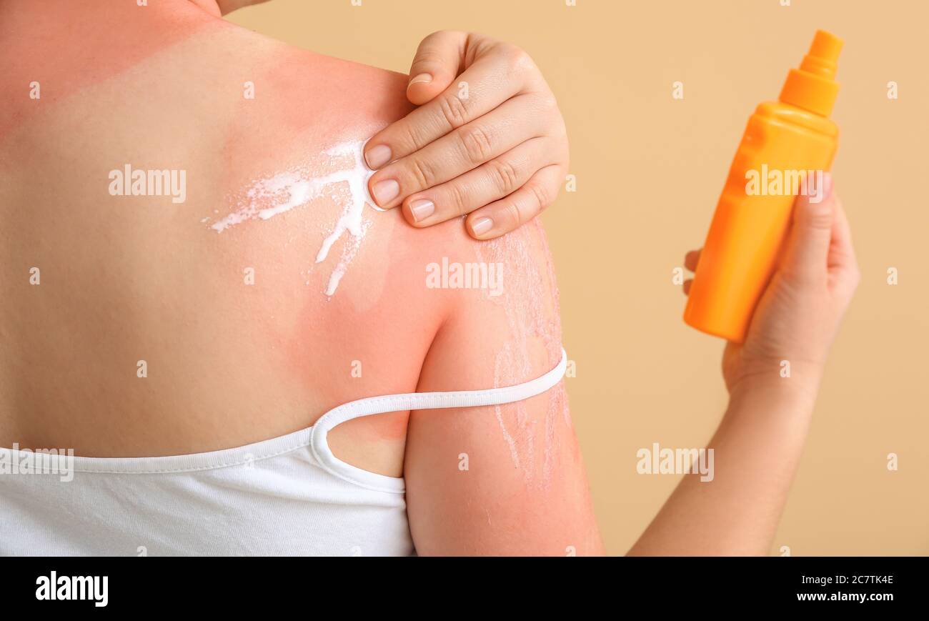 Woman with red sunburned skin applying cream against color background