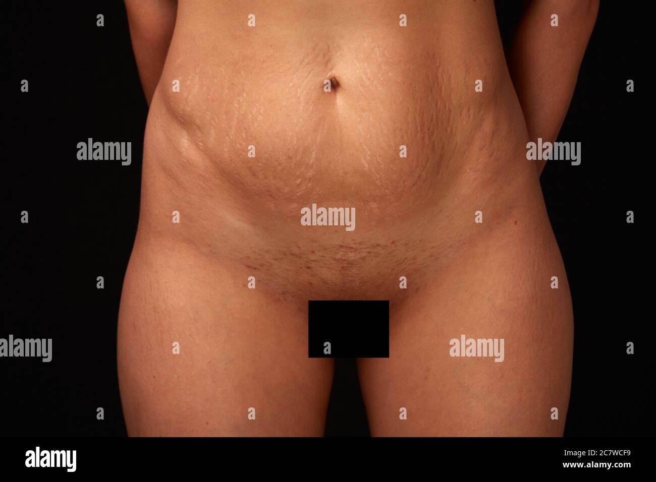 the body of a woman after childbirth on a black isolated background. visible stretch marks, changes in the abdomen. concept for medicine and cosmetolo Stock Photo