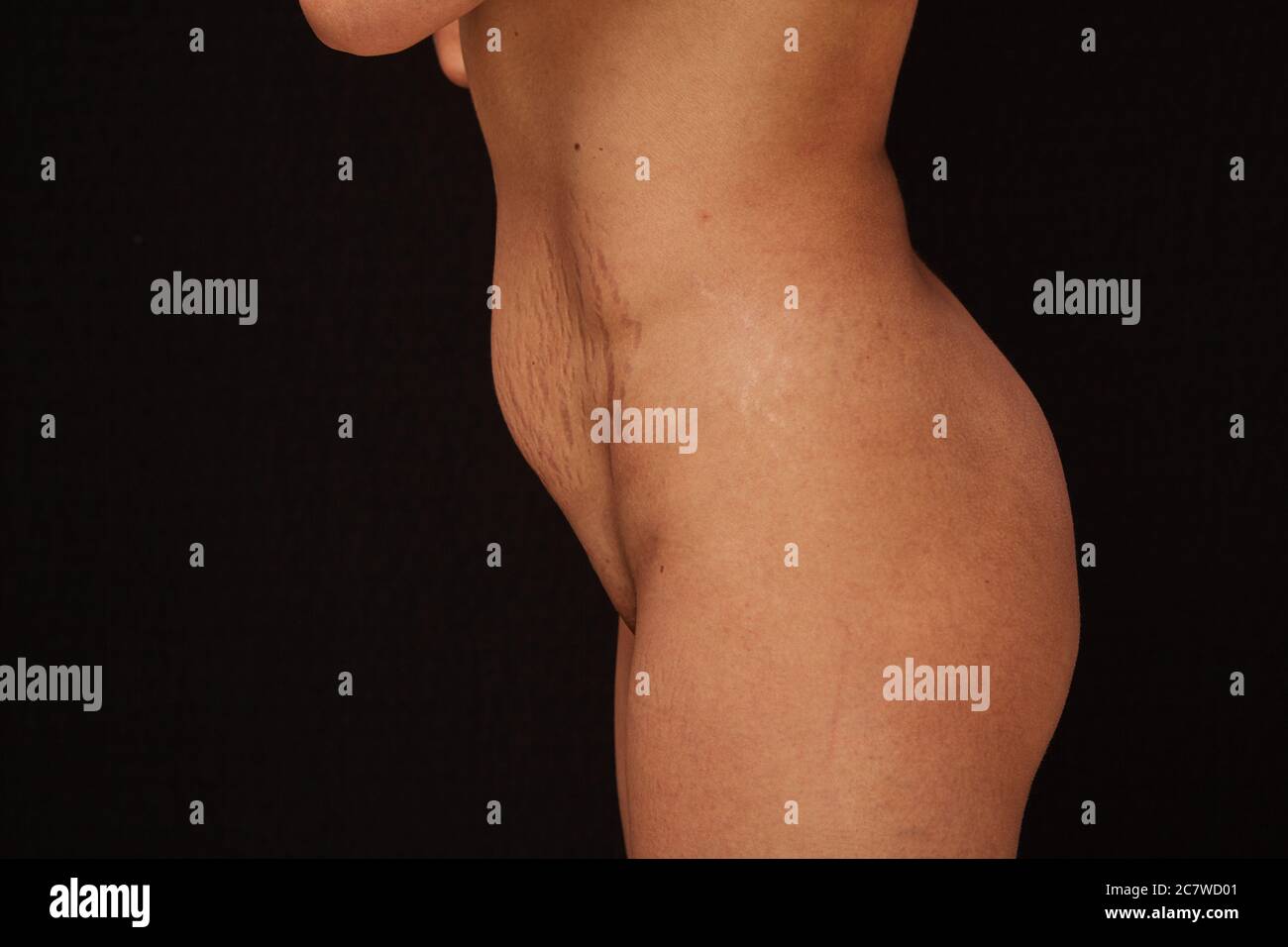 the body of a woman after childbirth on a black isolated background. visible stretch marks, changes in the abdomen. concept for medicine and cosmetolo Stock Photo