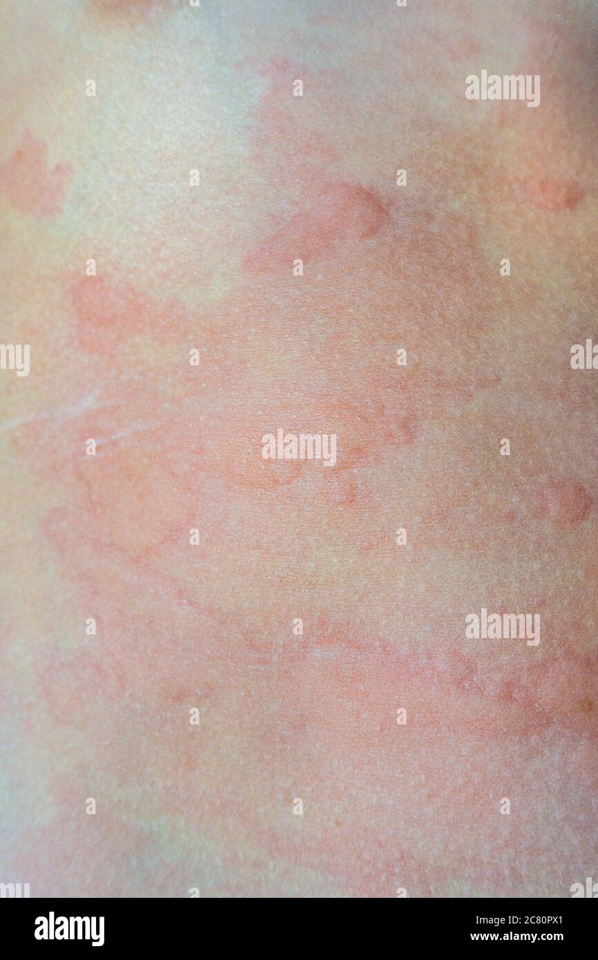 A child has broken out in hives, a raised angry red rash as a result of an allergic reaction. Stock Photo