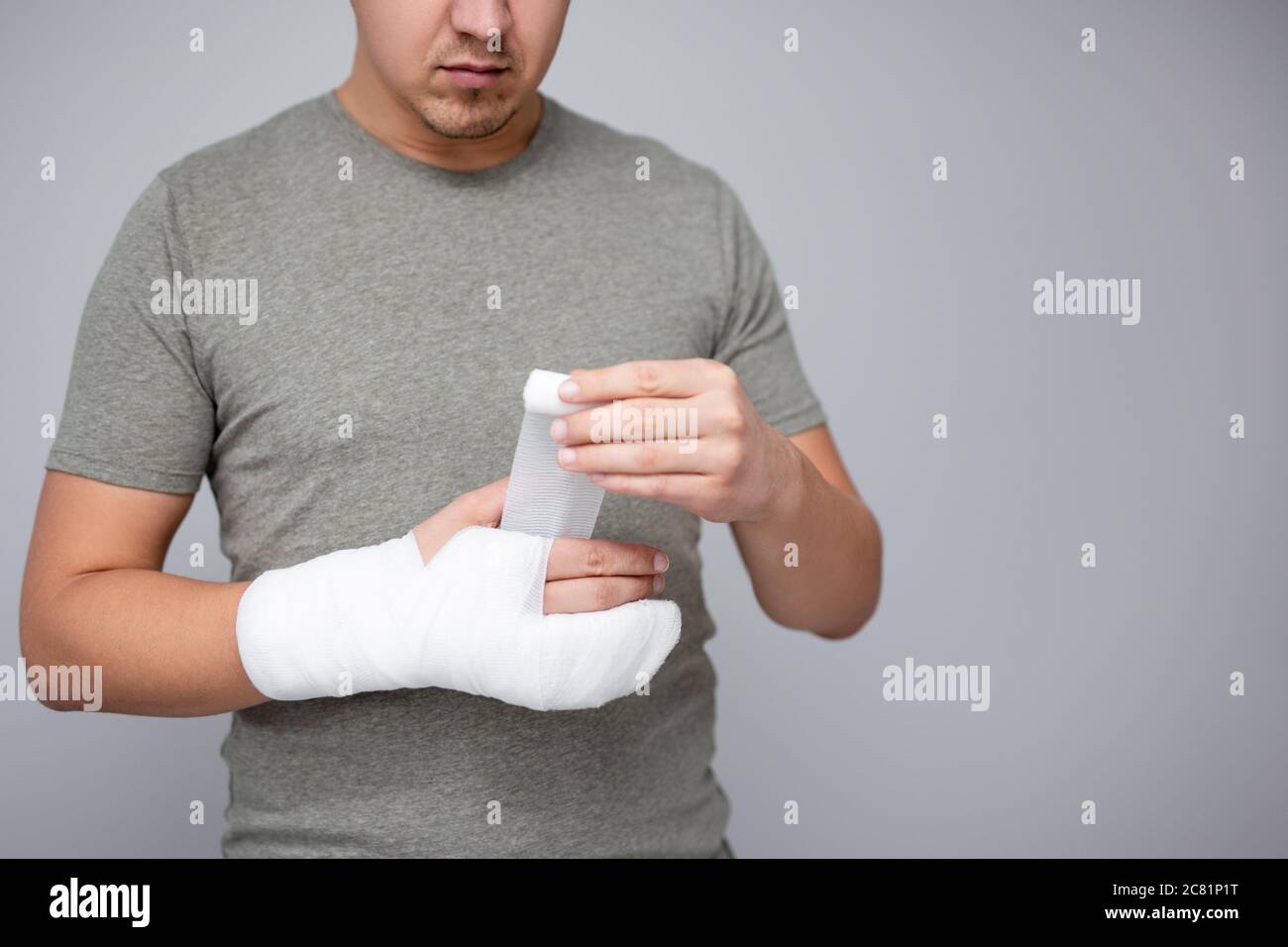 Hand Cast Fractured after an Accident Stock Photo - Image of hand