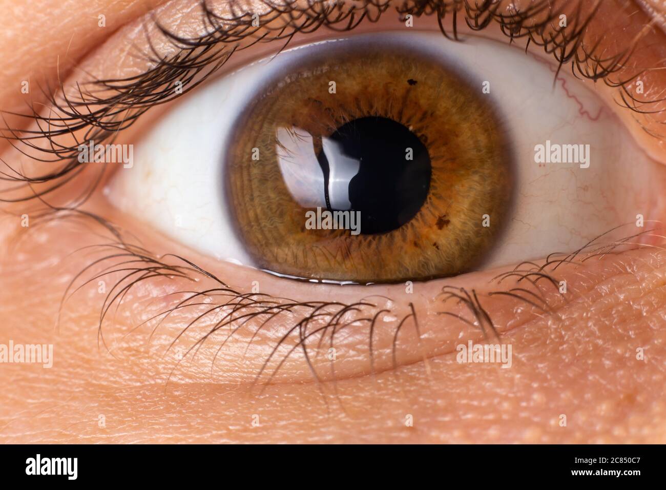 Macro eye photo. Keratoconus - eye disease, thinning of the cornea in the form of a cone. The cornea plastic. Stock Photo