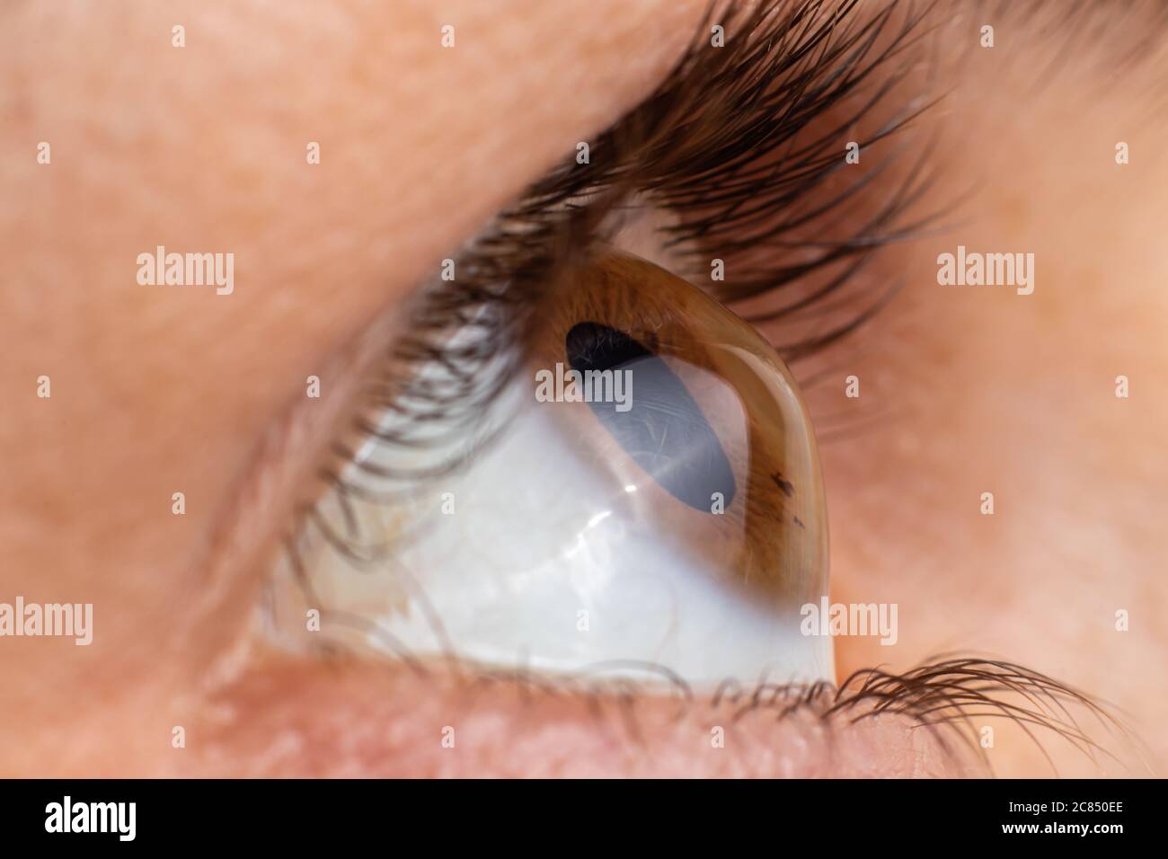 Keratoconus of eye, 4th degree. Contortion of the cornea in the form of a cone, deterioration of vision, astigmatism. Macro close up. Stock Photo