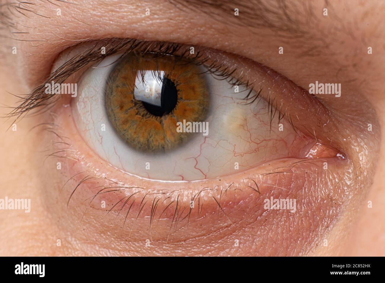 Pinguecula eyes macro photo close-up of the male eye. Yellow education on squirrel, farmer's eye. Stock Photo