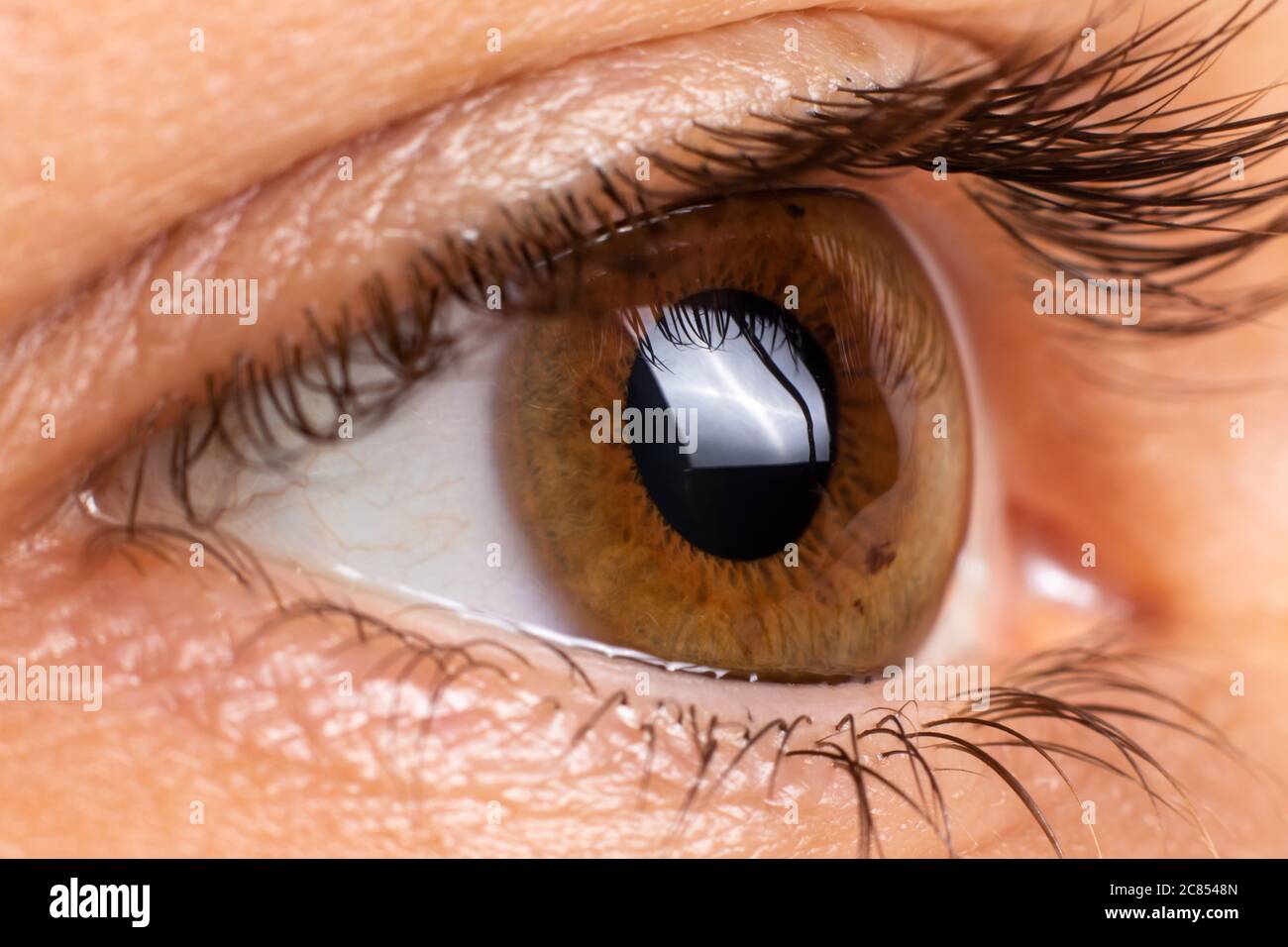 Macro eye photo. Keratoconus - eye disease, thinning of the cornea in the form of a cone. The cornea plastic. Stock Photo