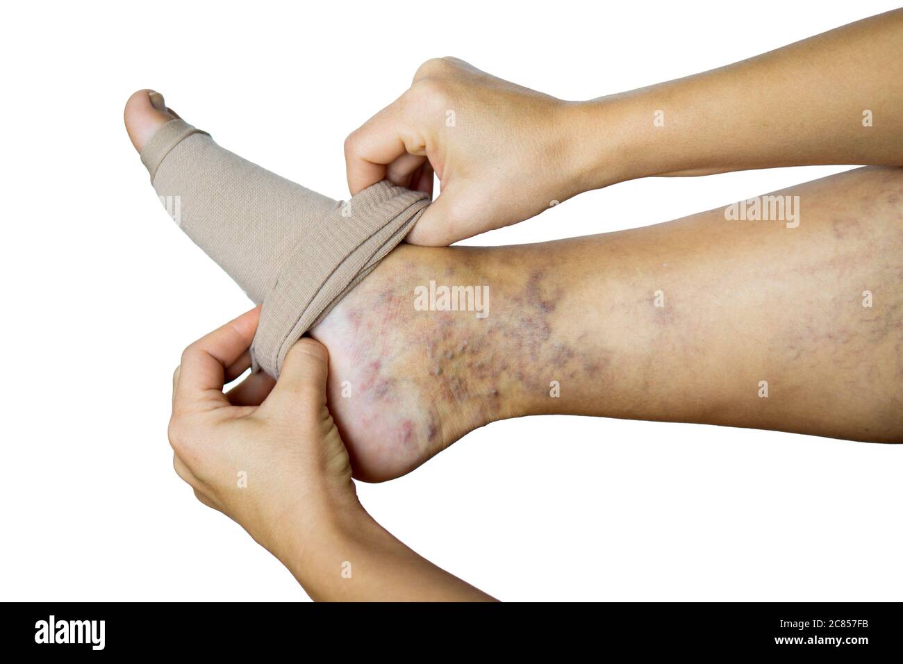 a woman puts a compression stocking on her leg with varicose veins. Varicose veins prevention, Compression tights, relief for tired legs. female legs Stock Photo