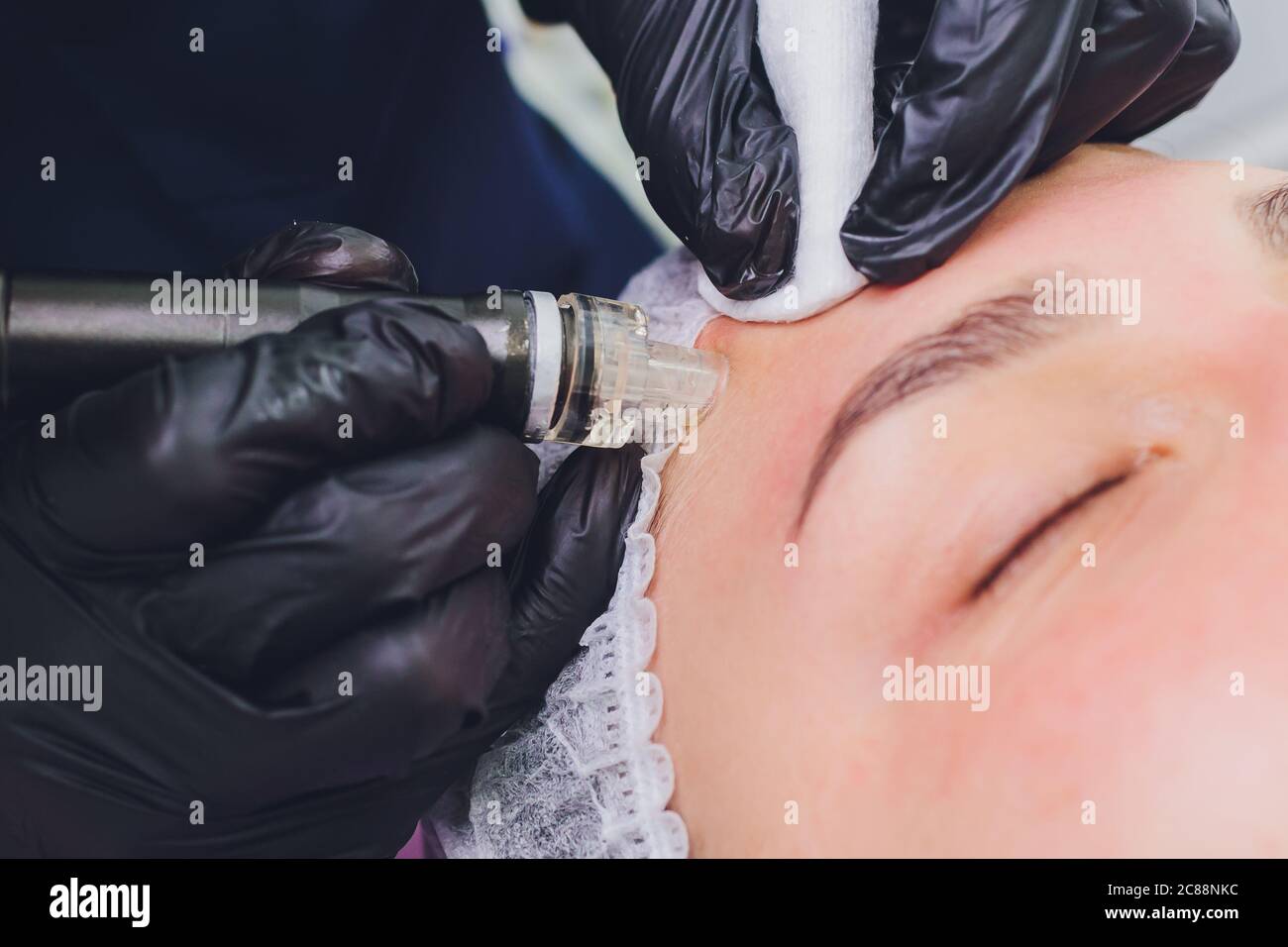 Dermabrasion girl's forehead. Instrumental cosmetology. Spa. Facial ...