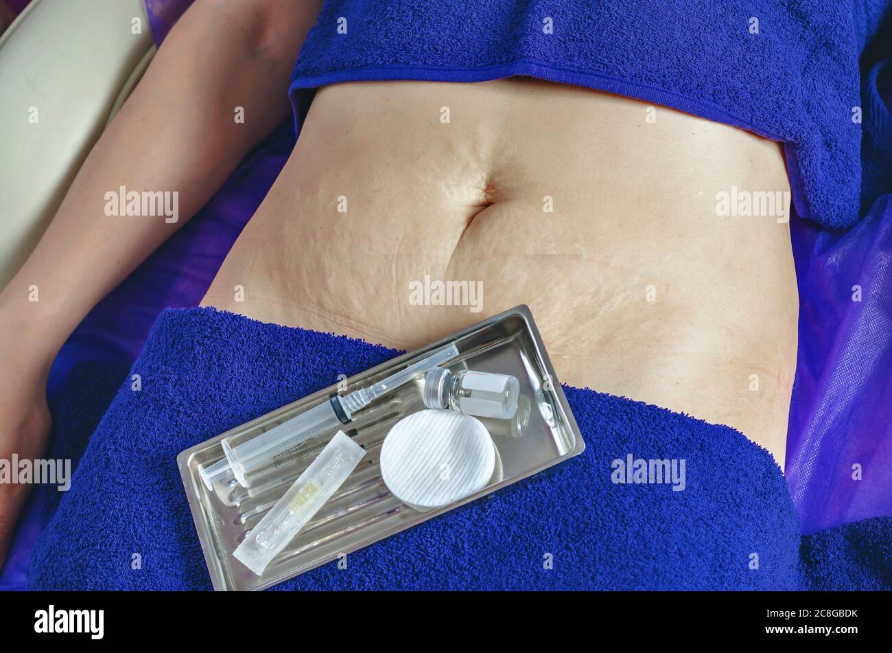 Female Abdomen With Stretch Marks Syringe And Ampoule Lie On The Navel On A Couch In Beauty Salon Cosmetic Procedure In A Salon Stock Photo Alamy