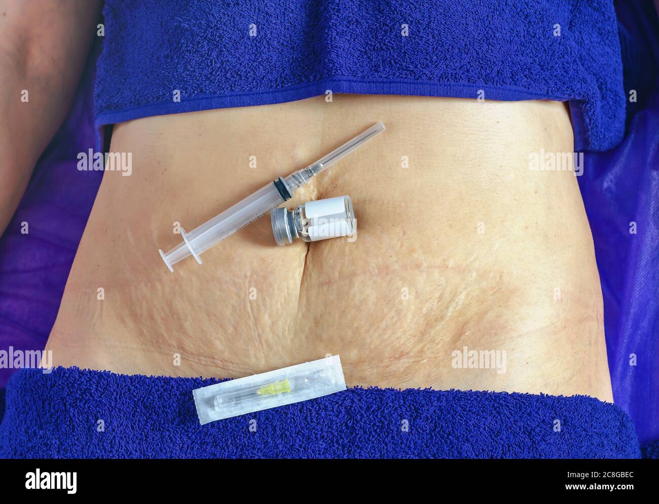 Female abdomen with stretch marks syringe and ampoule lie on the navel on a couch in beauty salon. Cosmetic procedure in a salon Stock Photo Alamy