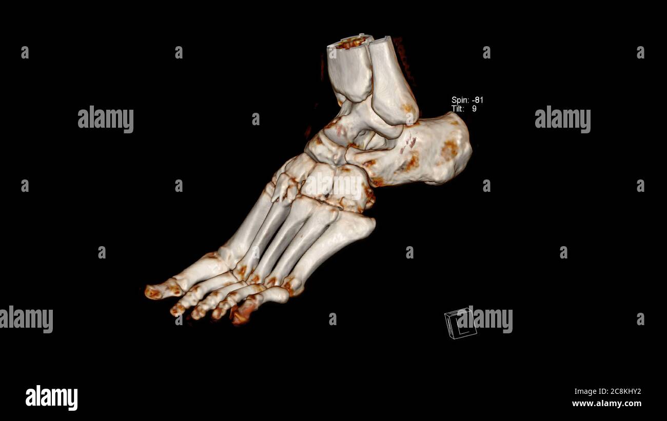 Computed Tomography Volume Rendering examination of the Foot ( CT VR Foot) . 3D rendering Stock Photo