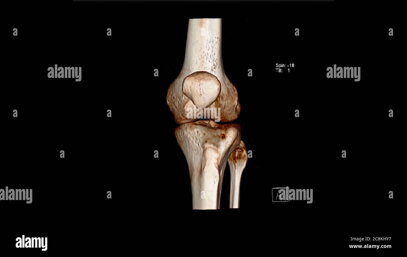 Computed Tomography Volume Rendering examination of the  Knee joint ( CT VR Knee) Stock Photo