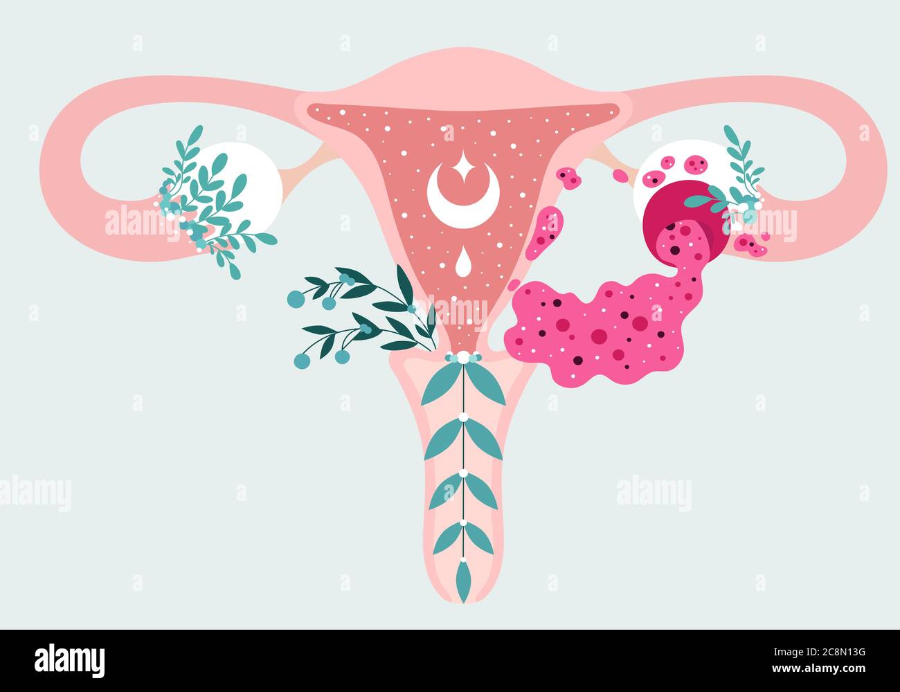 Patient-friendly Medical scheme of of Ovarian cyst rupture with leaking fluid. Gynecological uterus and appendages Stock Vector
