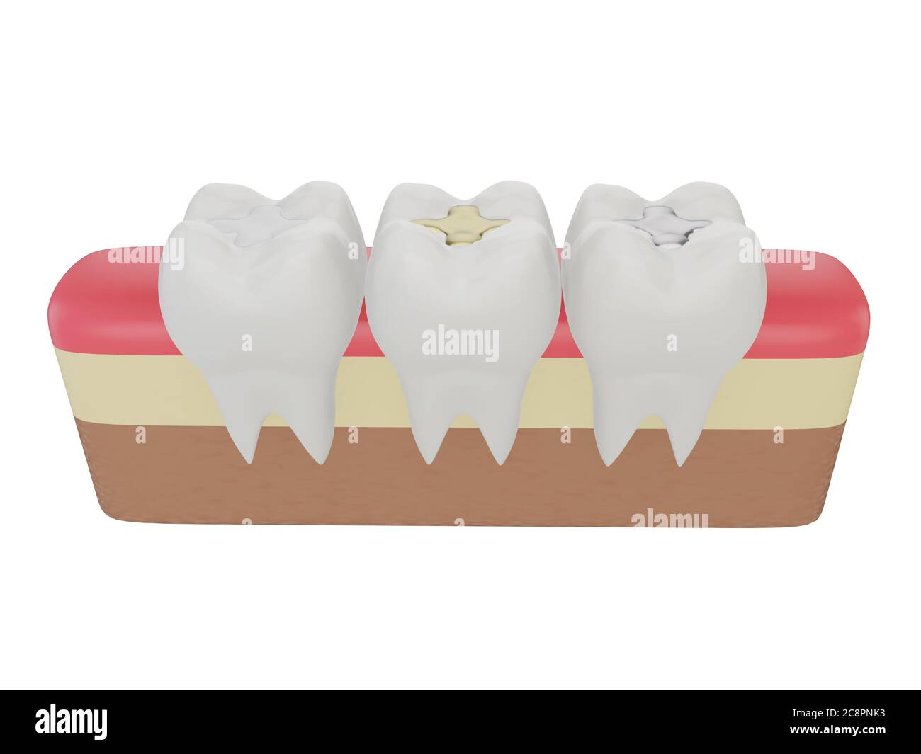 Teeth with gold, amalgam and composite inlay dental filling, three