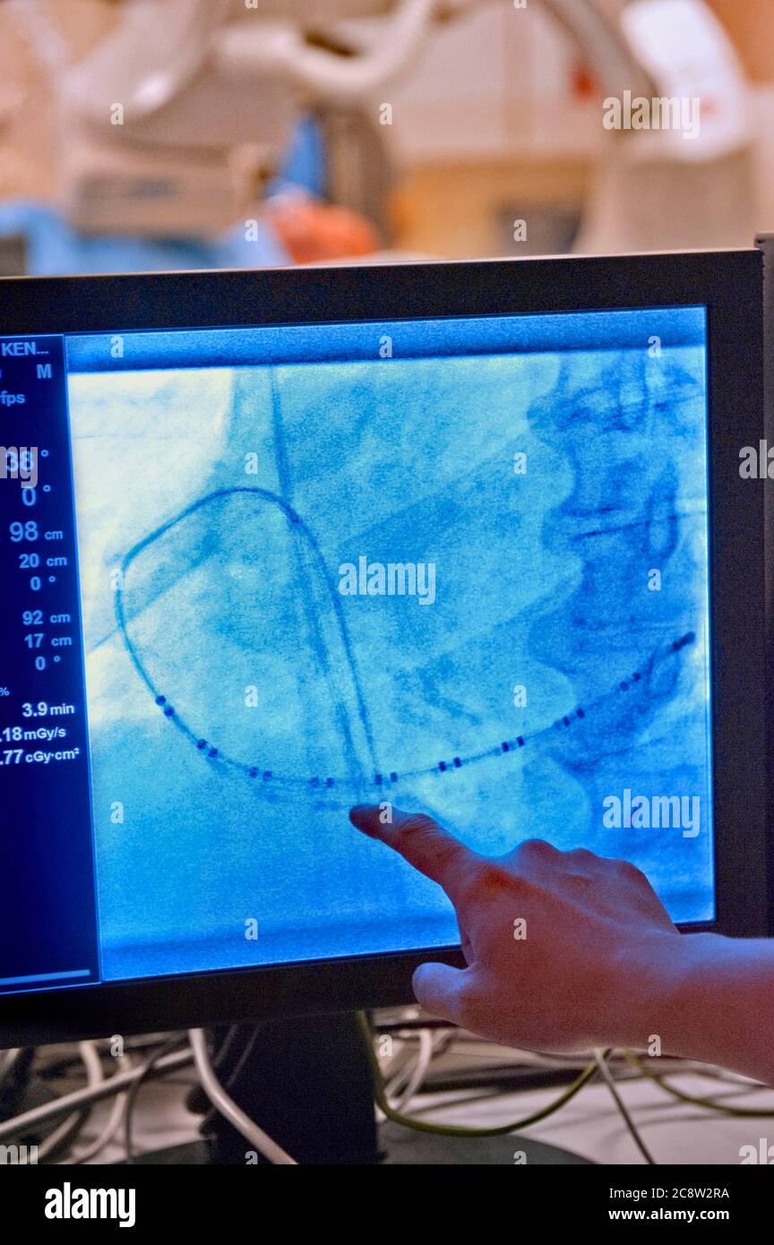 Atrial fibrillation ecg hi-res stock photography and images - Alamy