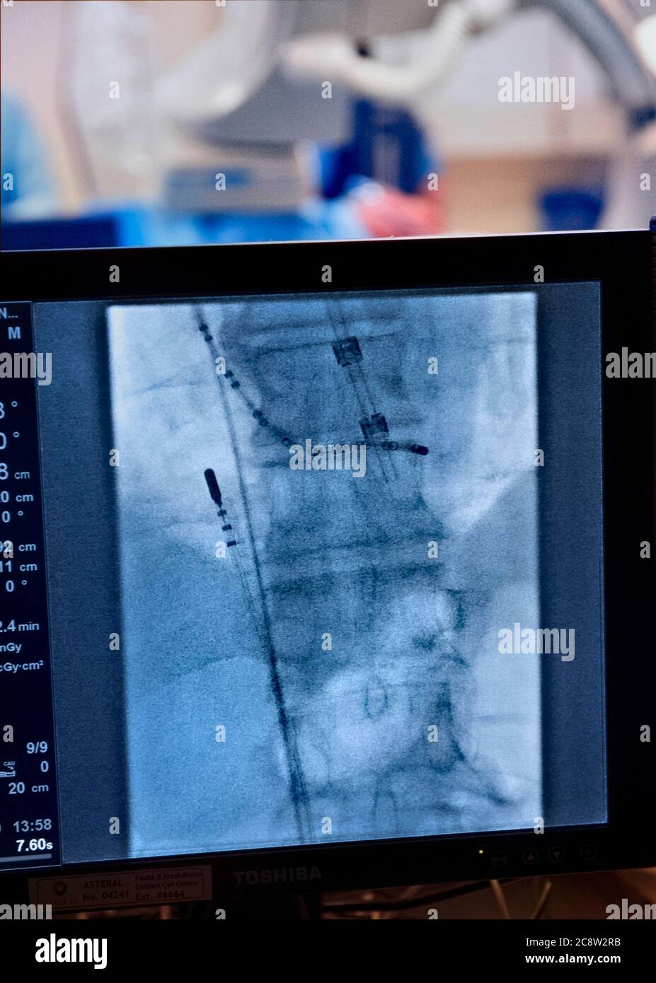 Atrial fibrillation of the heart hi-res stock photography and images ...