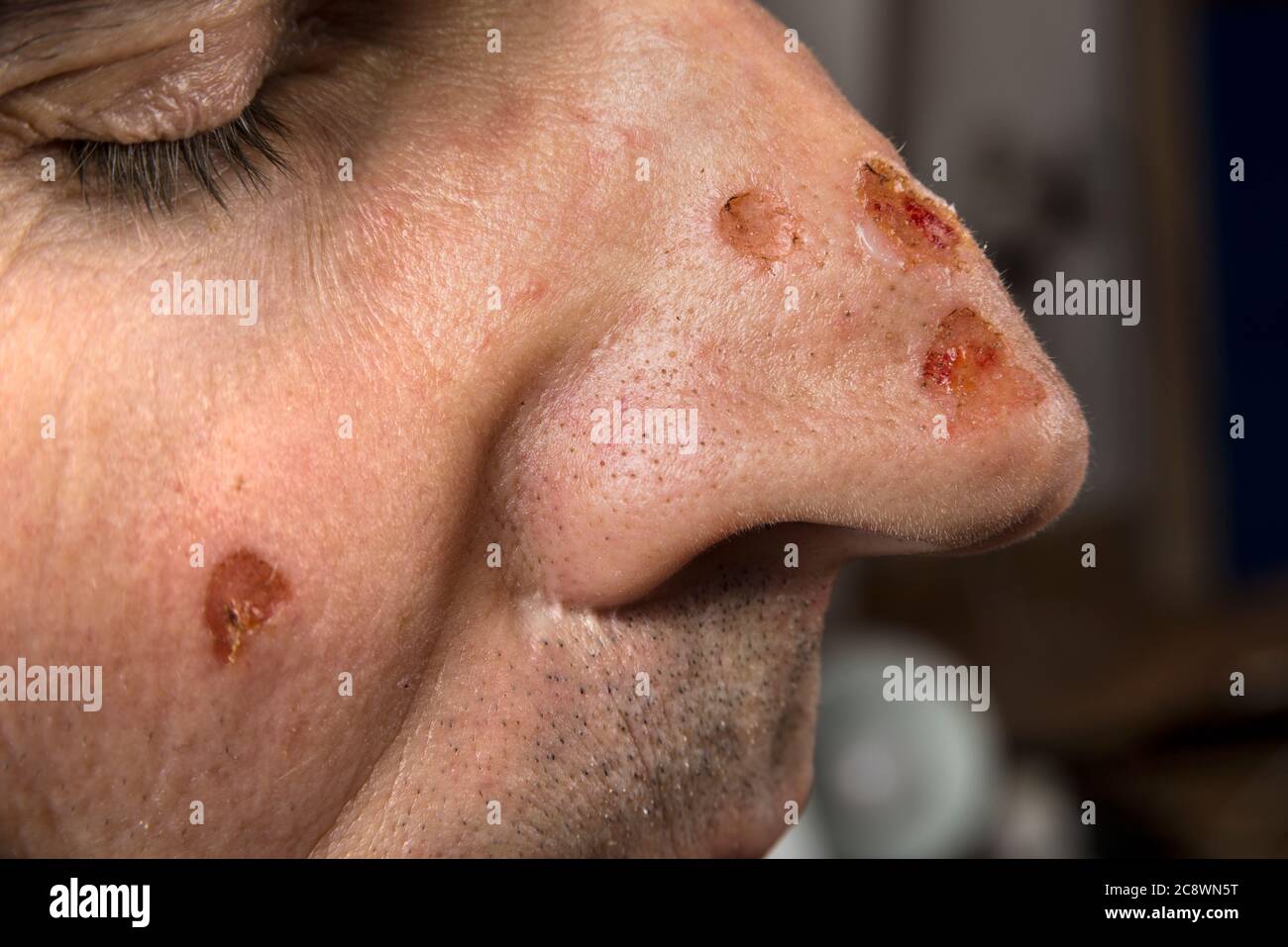Wound from laser on a face from dermatologist Stock Photo - Alamy