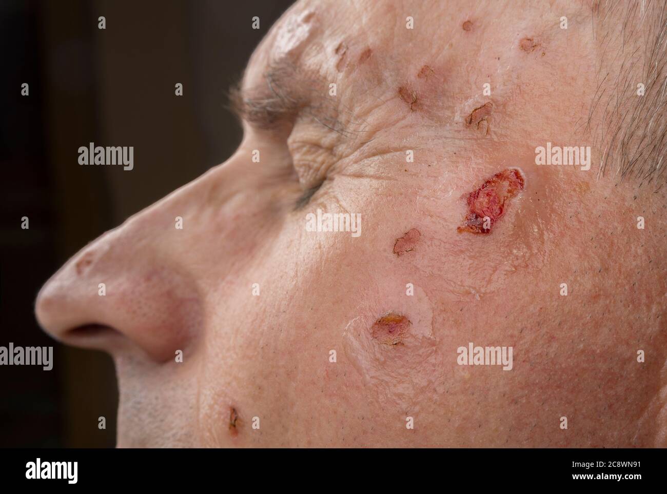 Wound from laser on a face from dermatologist Stock Photo Alamy
