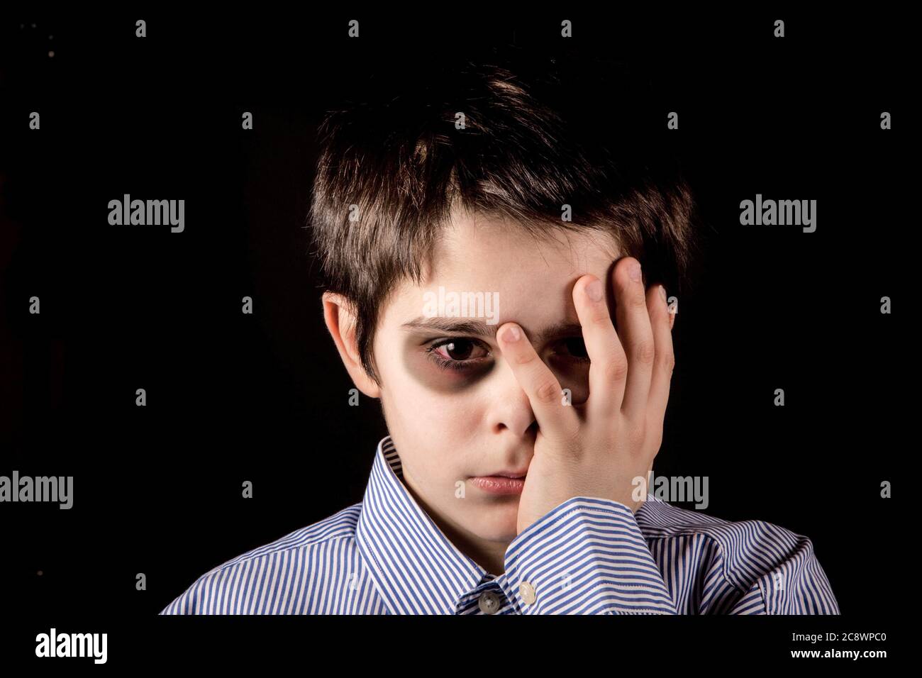 little boy with black eye Stock Photo - Alamy